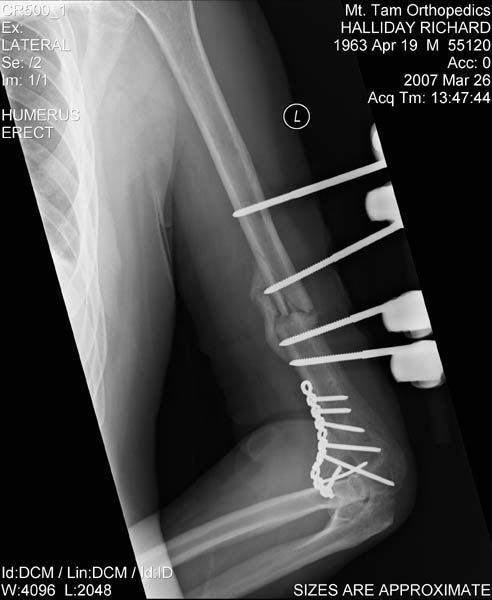 Left Arm
